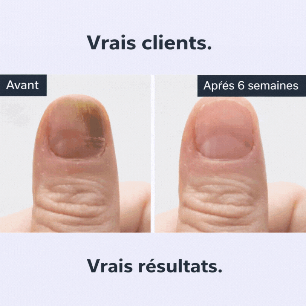 Qilova – Stylo antifongique pour ongles