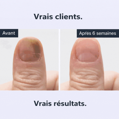 Qilova – Stylo antifongique pour ongles